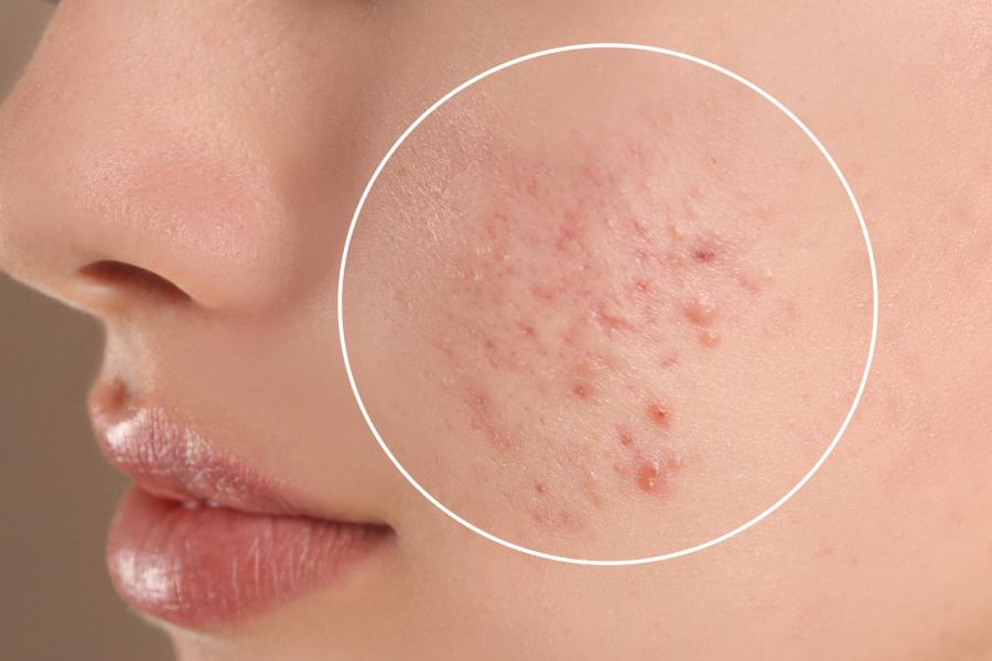 Acne Marks and Scar Treatment