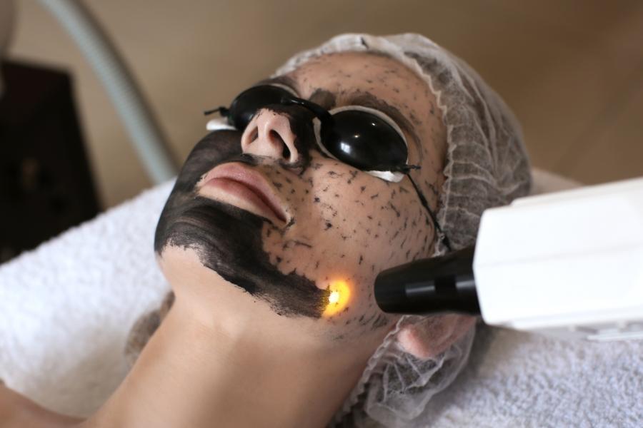 Carbon Laser Facials