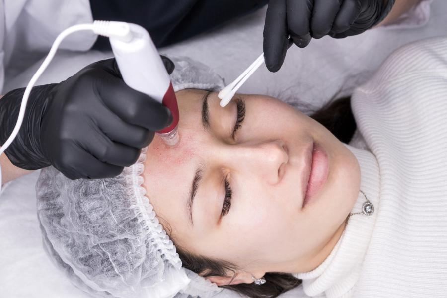 Micro Needling and Mesotherapy (Skin and Hair)