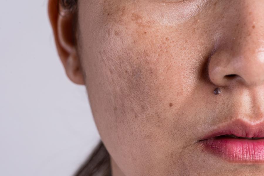 Pigment Correction (Melasma)