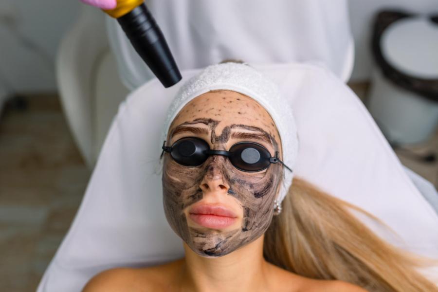 Carbon Peel Laser Treatment