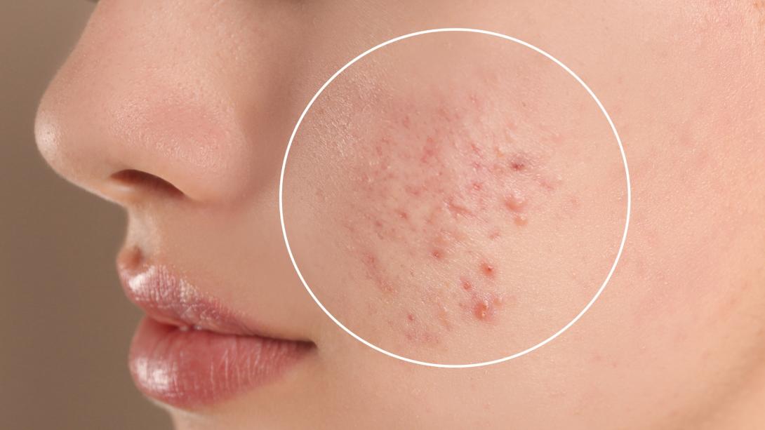 Acne Marks and Scar Treatment