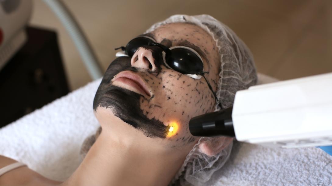 Carbon Laser Facials