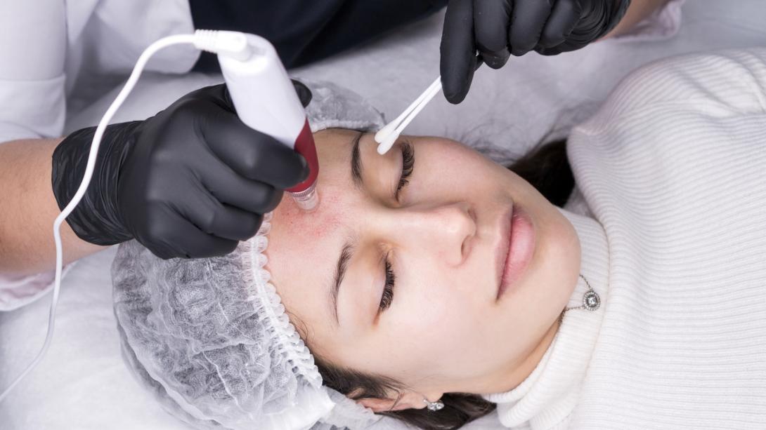 Micro Needling and Mesotherapy (Skin and Hair)