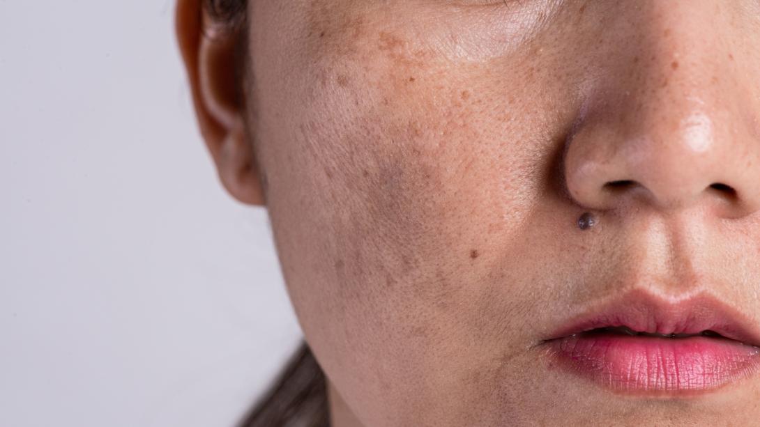 Pigment Correction (Melasma)