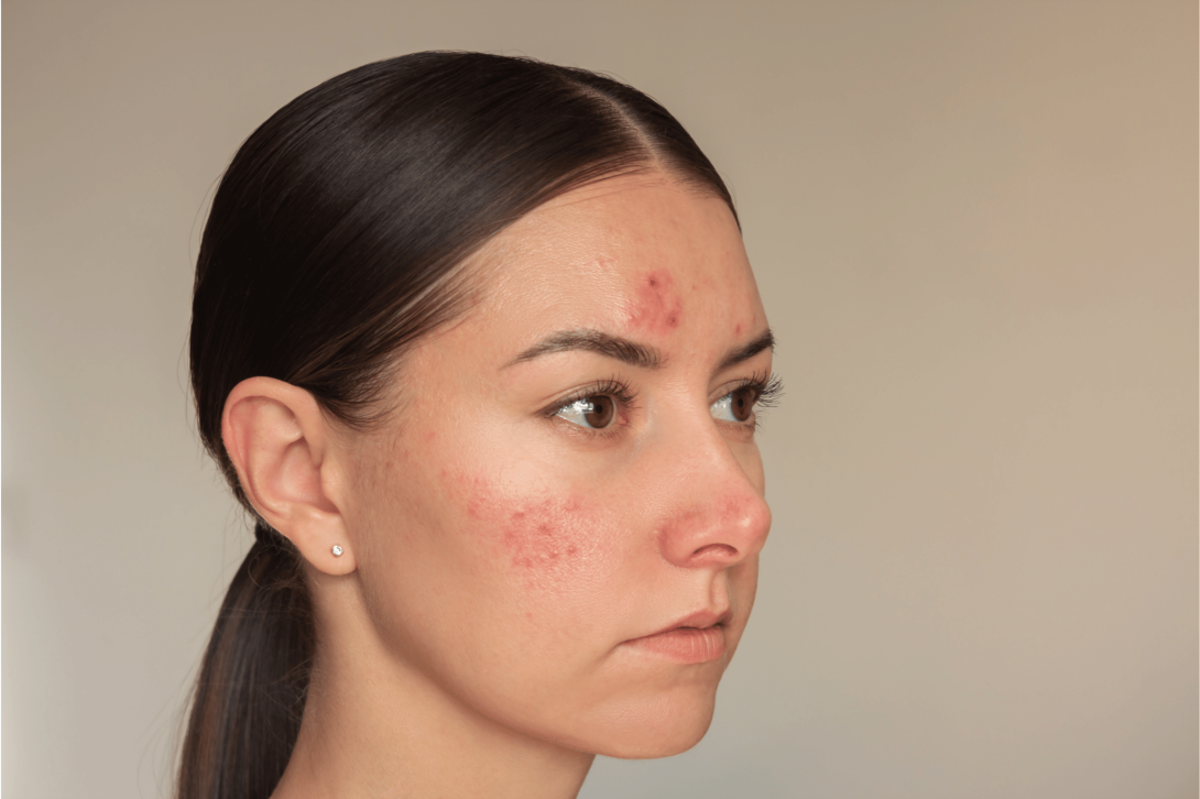 Melasma and Hyperpigmentation